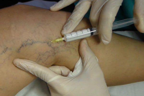 ESCLEROTERAPIA INYECCIÓN DE ESPUMA