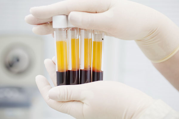 PLASMA RICO EN PLAQUETAS EN TUBOS YA CENTRIFUGADOS