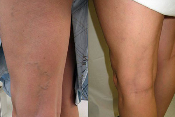 ESCLEROTERAPIA ANTES Y DESPUES