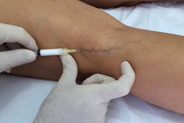 ESCLEROTERAPIA EN LAS VARICES