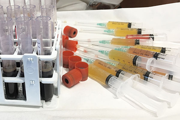 TRATAMIENTO AUMETO DE GLUTEOS CON PLASMA GEL