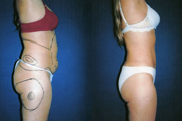 HIDROLIPOCLASIA REDUCE MEDIDAS