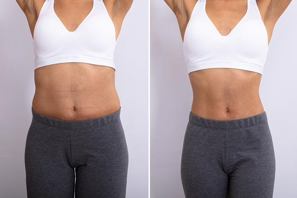 HIDROLIPOCLASIA ANTES Y DESPUES
