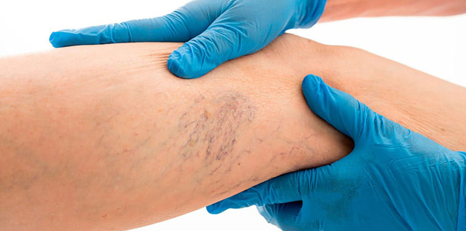 LA ESCLEROTERAPIA UN TRATAMIENTO EFECTIVO